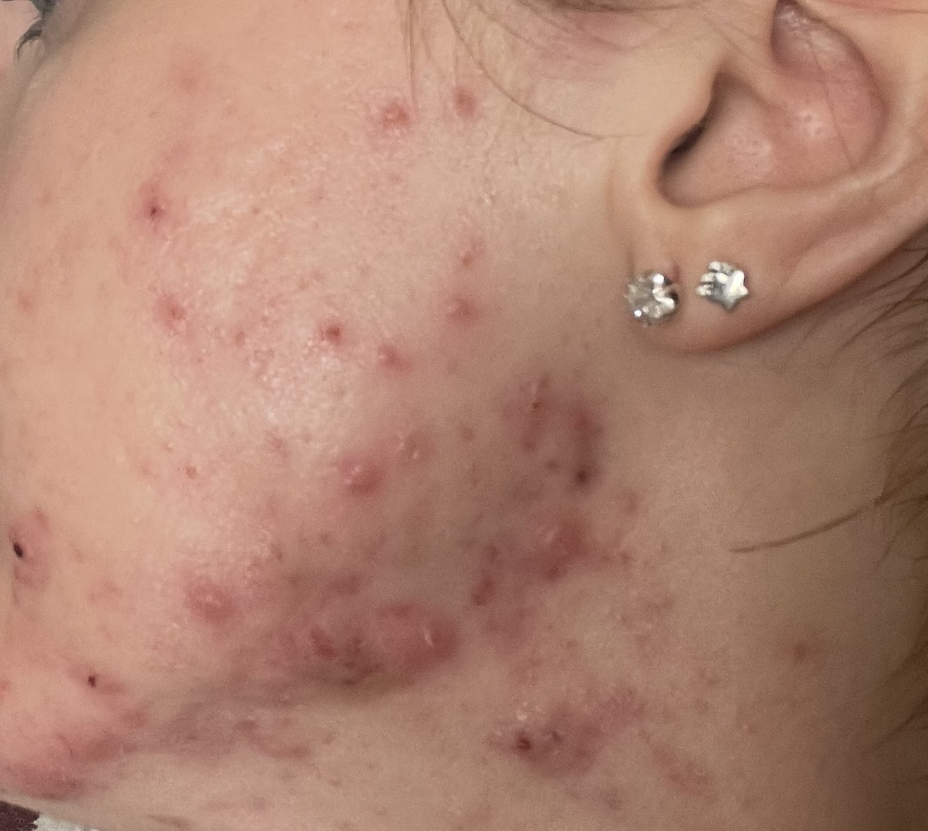 Sarah's skin before treatment