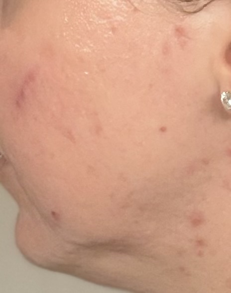 Sarah's skin after treatment